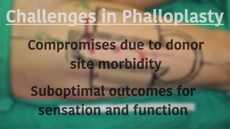 phalloplasty healed results|Phalloplasty: techniques and outcomes .
